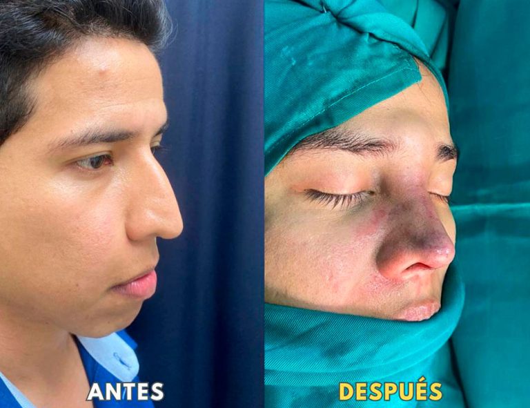 Post-operatorio inmediato