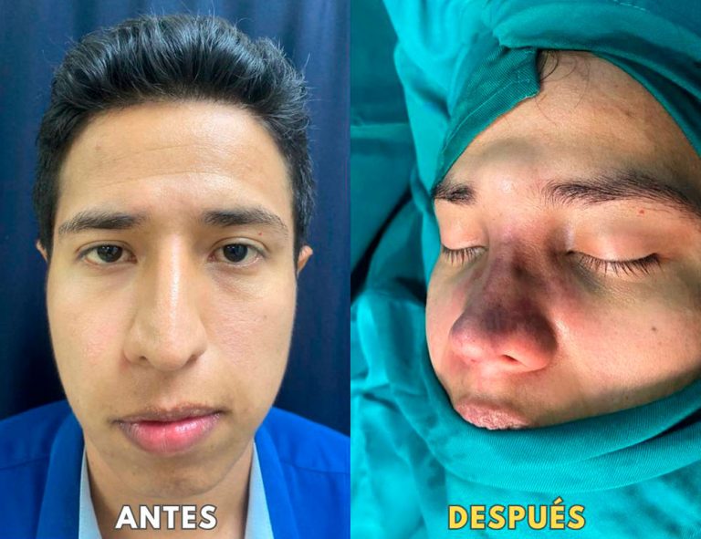 Post-operatorio inmediato