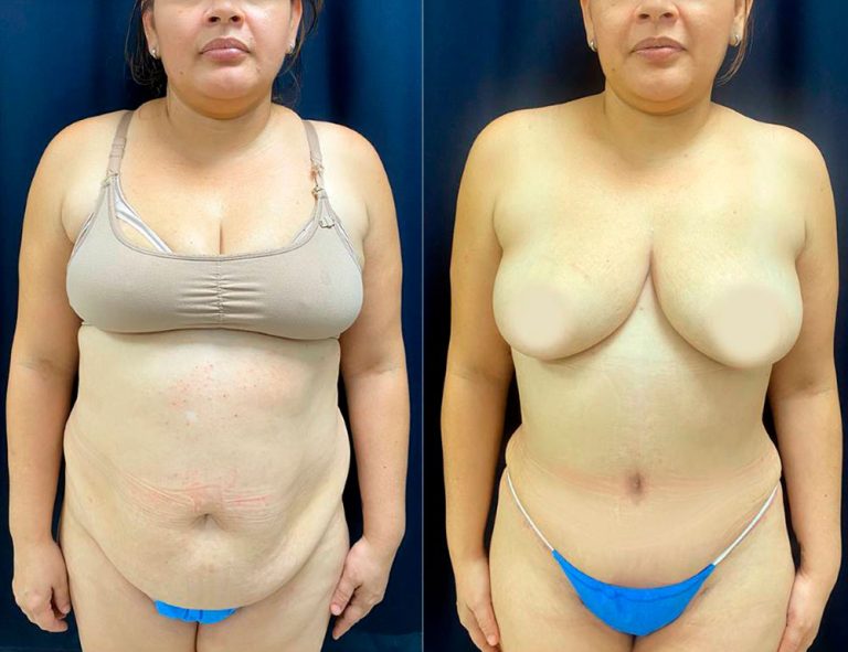 Abdominoplastia (3 meses)