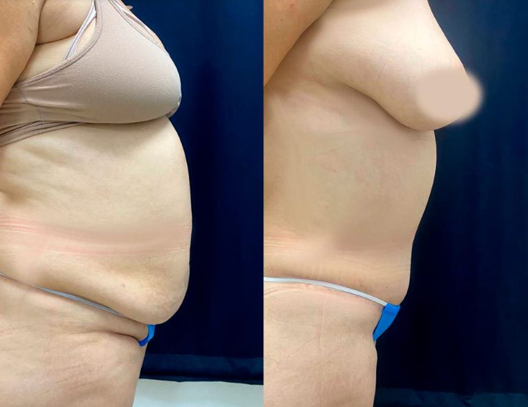 Abdominoplastia (3 meses)