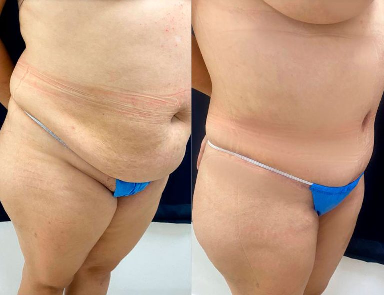 Abdominoplastia (3 meses)