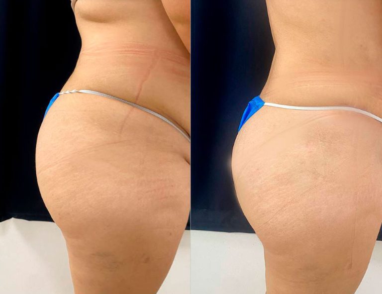 Abdominoplastia (3 meses)