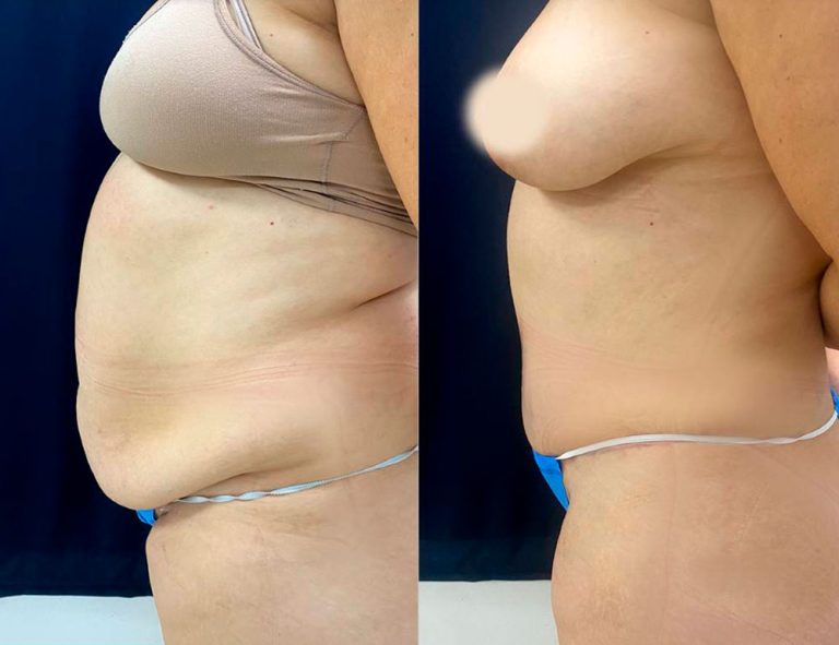 Abdominoplastia (3 meses)