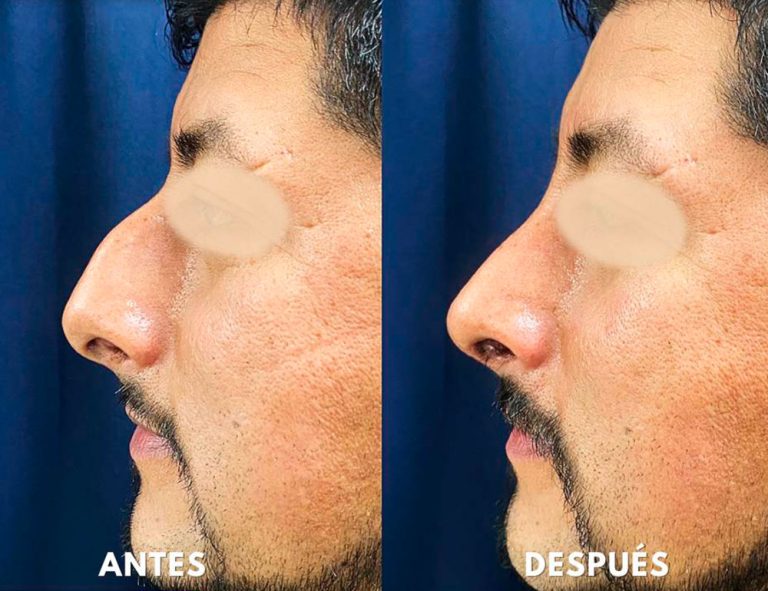 Post-operatorio (40 días)