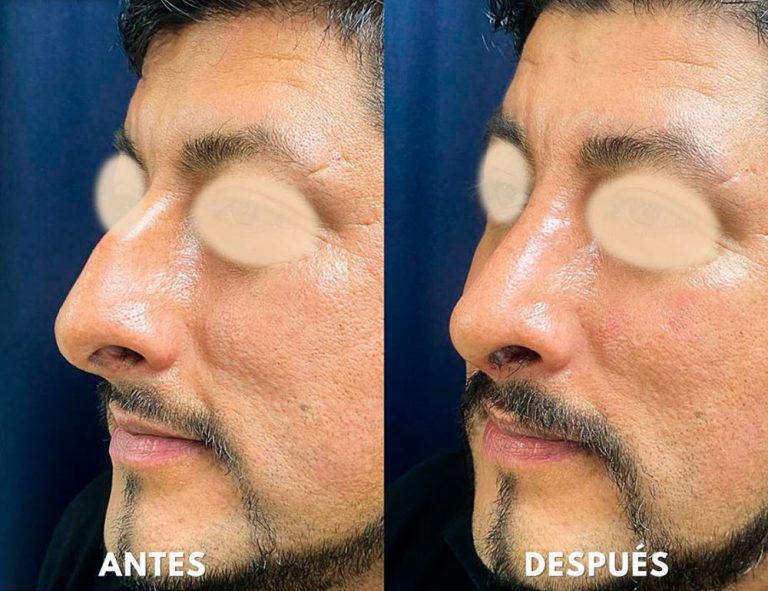 Post-operatorio (40 días)