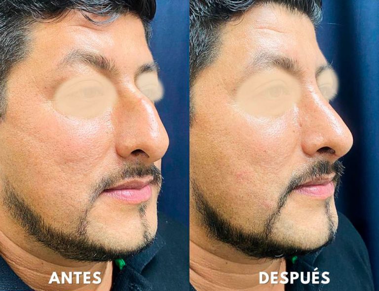 Post-operatorio (40 días)