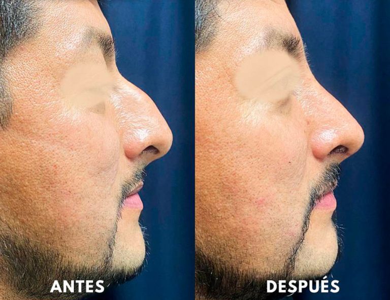 Post-operatorio (40 días)