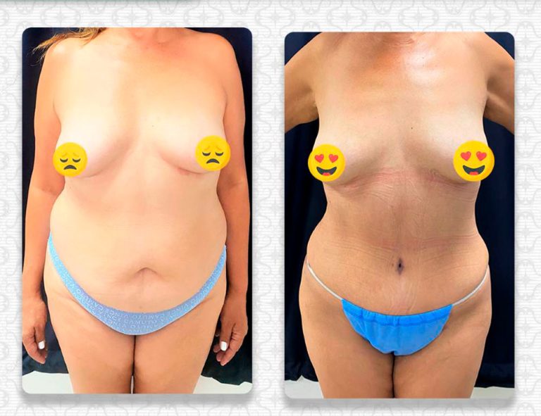 Abdominoplastia (3 meses)