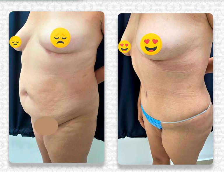 Abdominoplastia (3 meses)