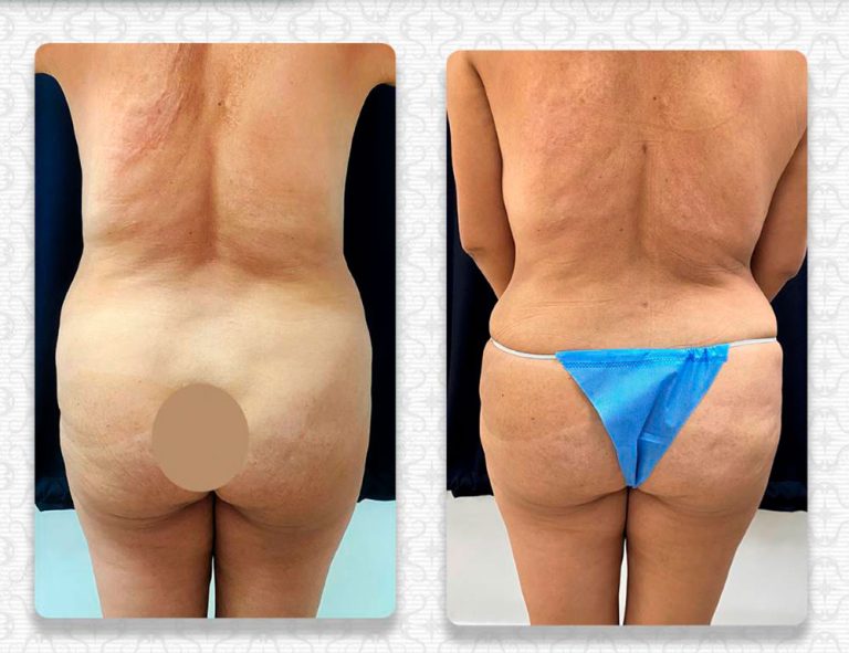 Abdominoplastia (3 meses)