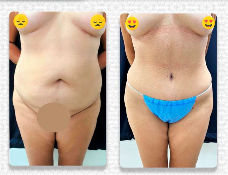 Abdominoplastia (3 meses)