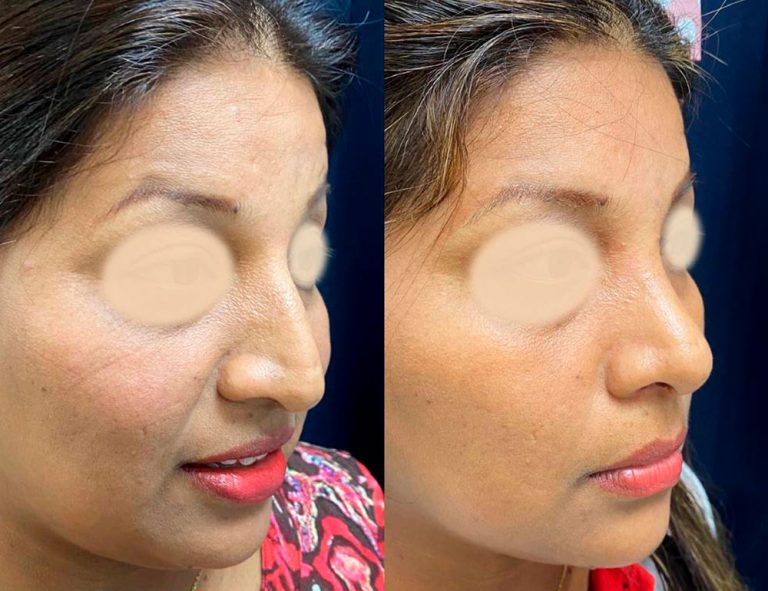 Rinoplastia (2 meses)