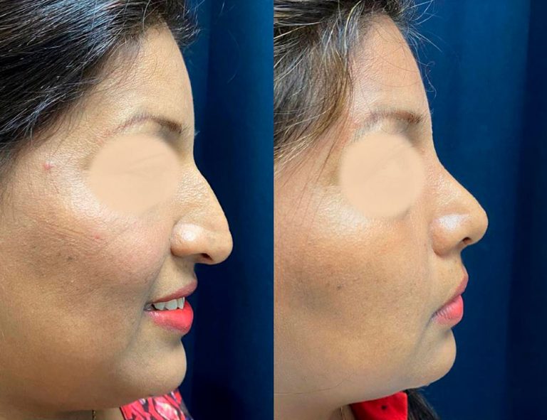 Rinoplastia (2 meses)