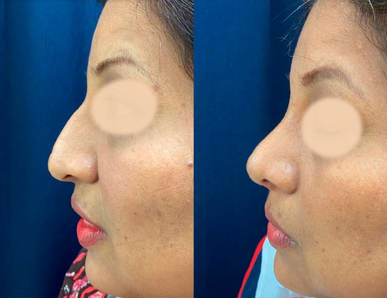 Rinoplastia (2 meses)