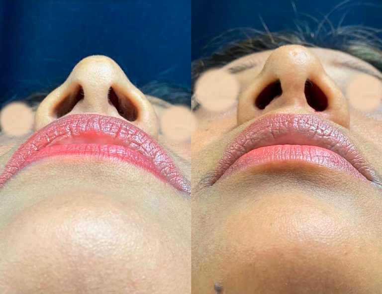 Rinoplastia (2 meses)