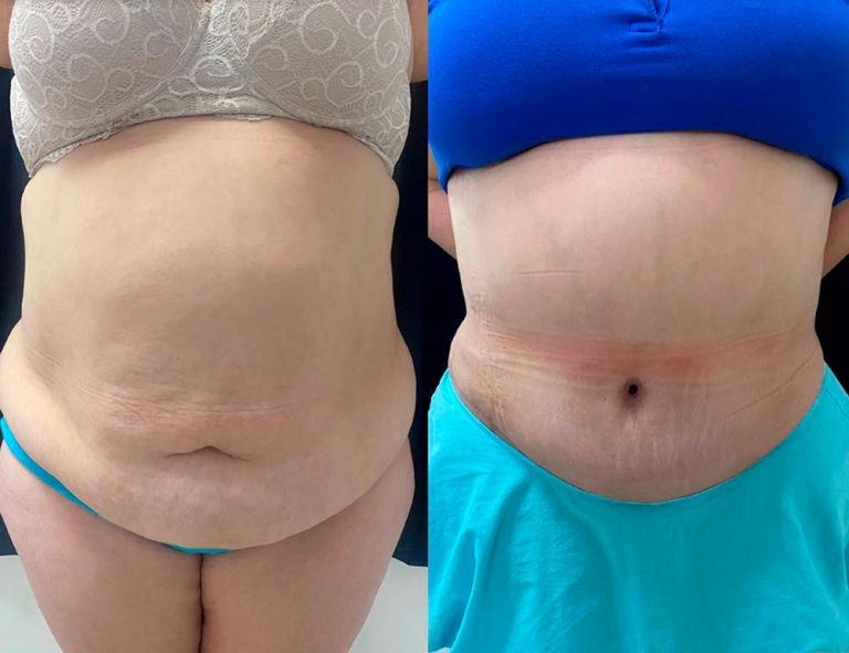 Lipoabdominoplastia (1 mes)