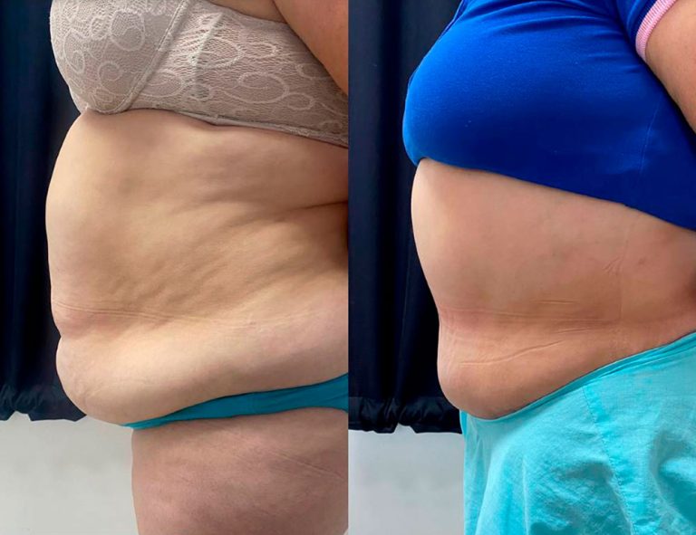 Lipoabdominoplastia (1 mes)