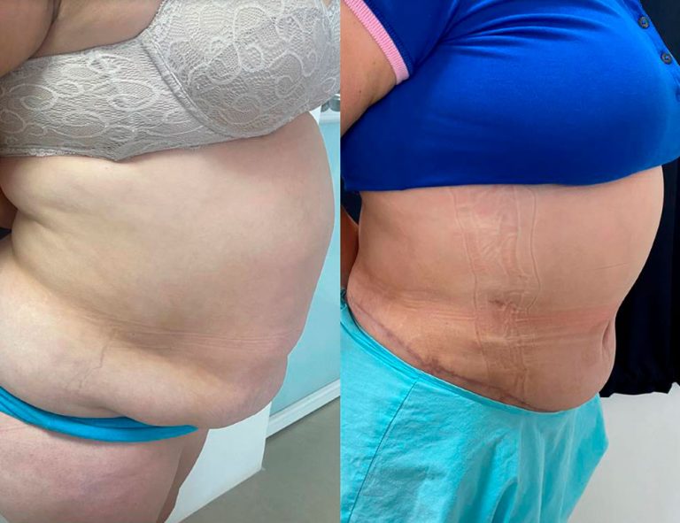 Lipoabdominoplastia (1 mes)