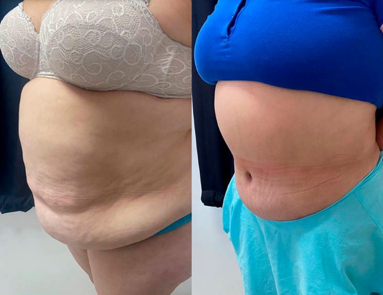 Lipoabdominoplastia (1 mes)