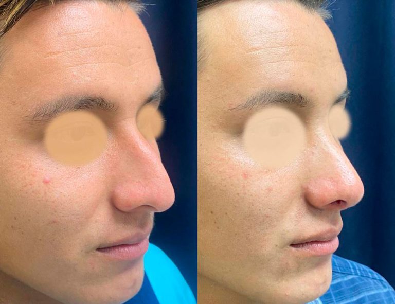 Rinoplastia (40 días)