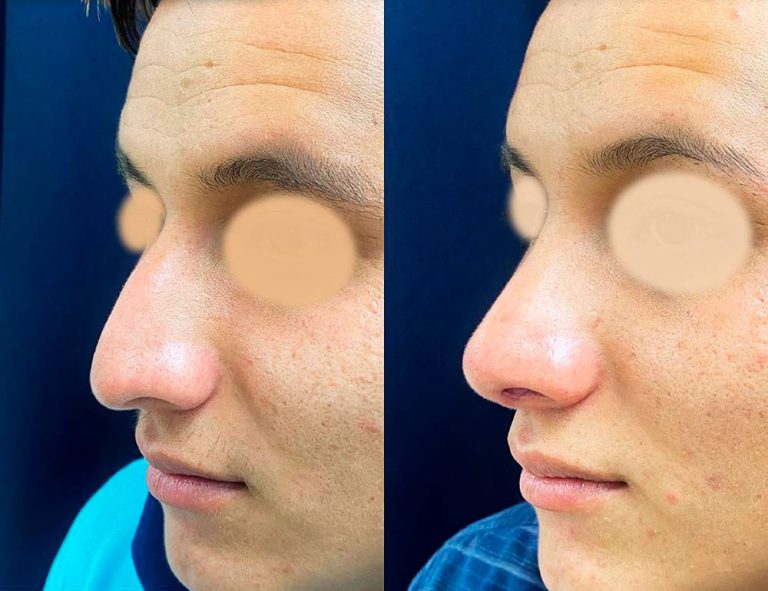 Rinoplastia (40 días)