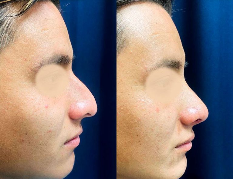 Rinoplastia (40 días)