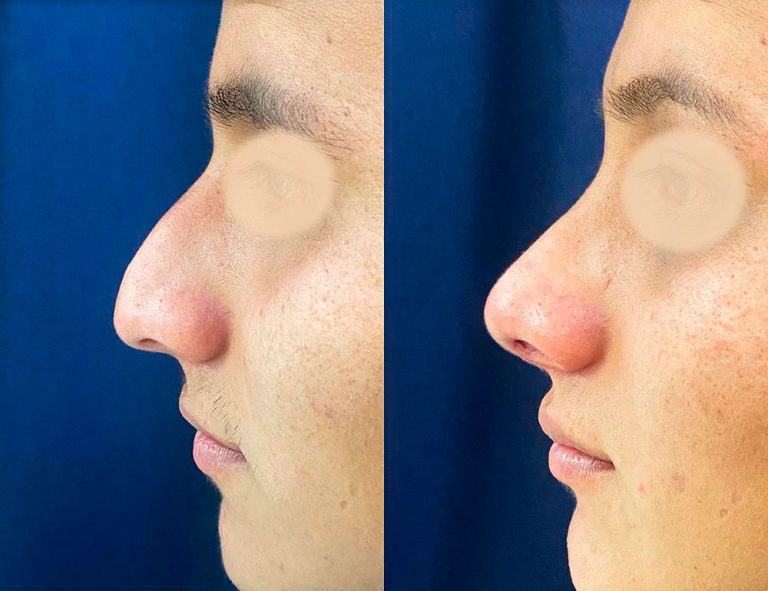 Rinoplastia (40 días)