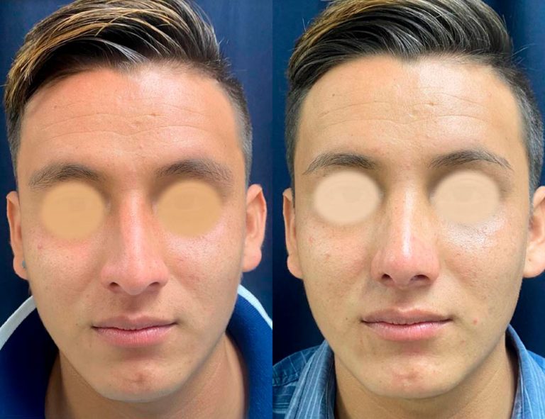 Rinoplastia (40 días)