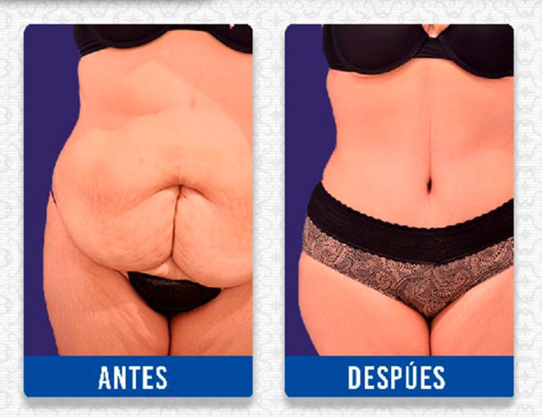 Lipoabdominoplastia