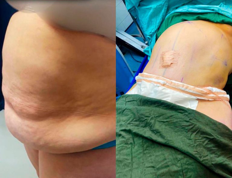 Lipoabdominoplastia