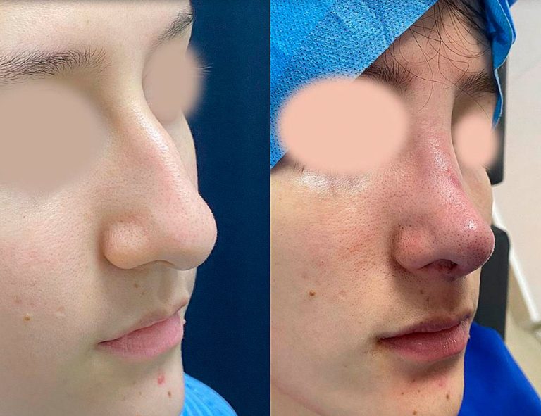 Rinoplastia (post-cirugía)