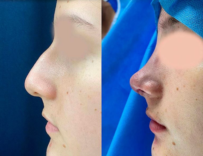 Rinoplastia (post-cirugía)
