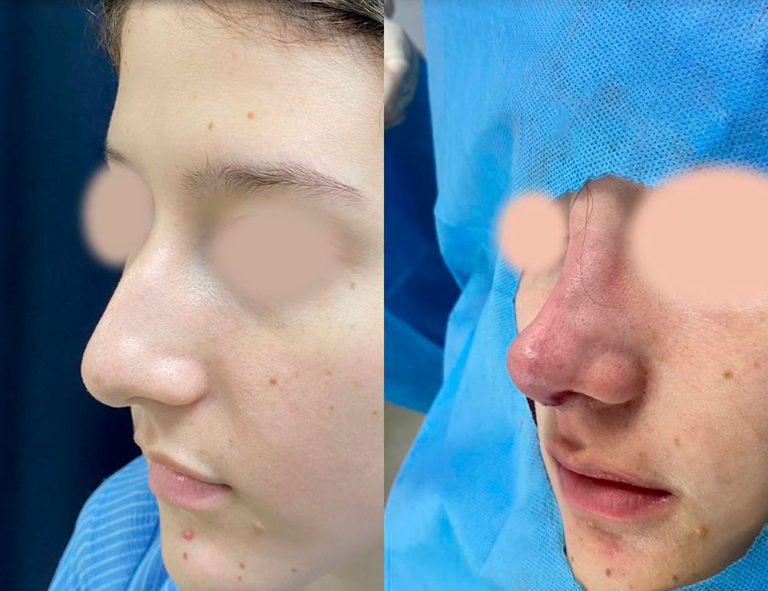 Rinoplastia (post-cirugía)