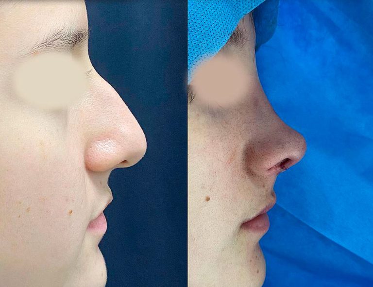 Rinoplastia (post-cirugía)