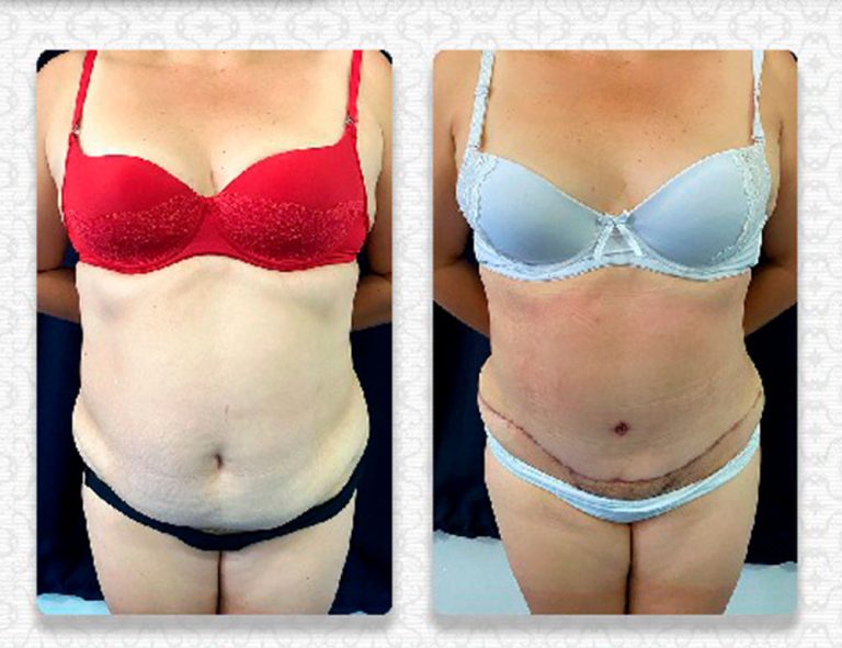 Lipoabdominoplastia (1 mes)