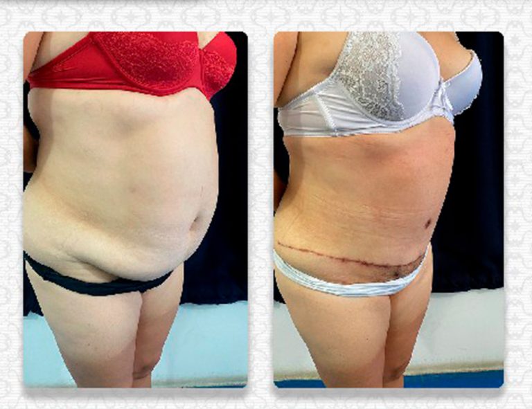 Lipoabdominoplastia (1 mes)