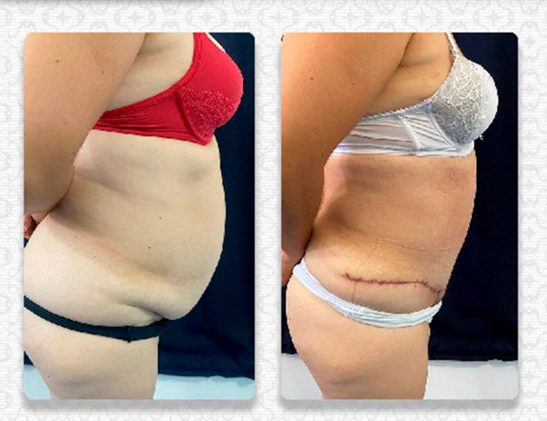 Lipoabdominoplastia (1 mes)
