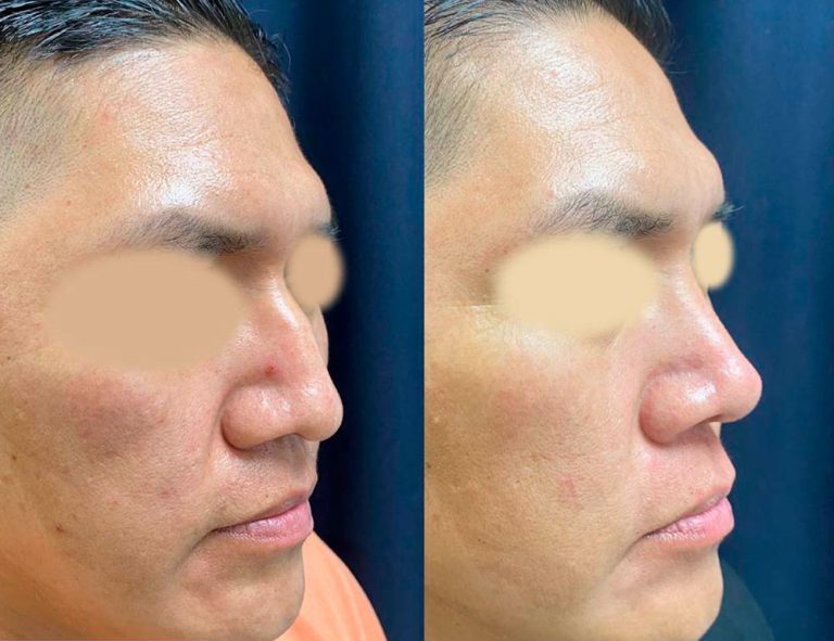 Rinoplastia (3 meses)