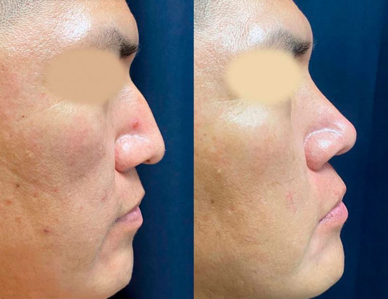 Rinoplastia (3 meses)