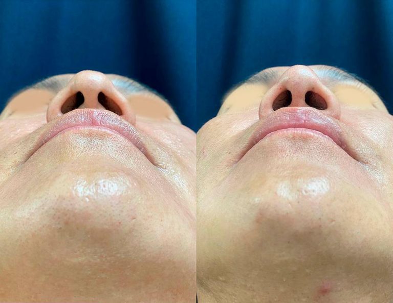 Rinoplastia (3 meses)