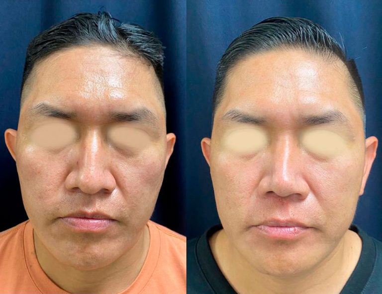 Rinoplastia (3 meses)