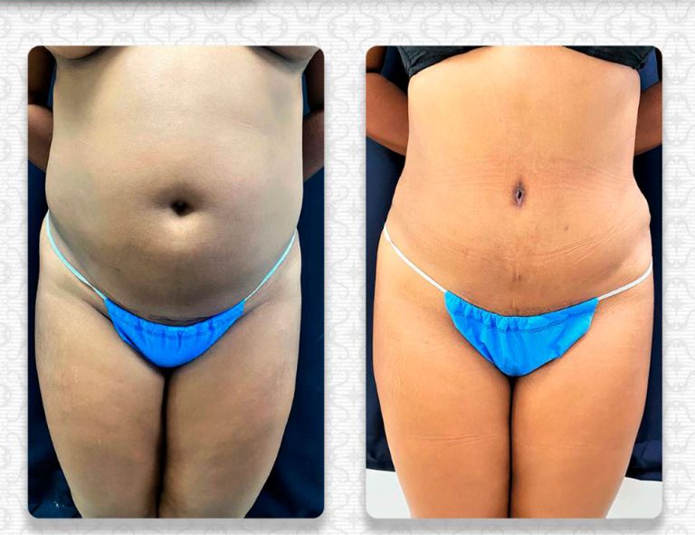 Lipoabdominoplastia