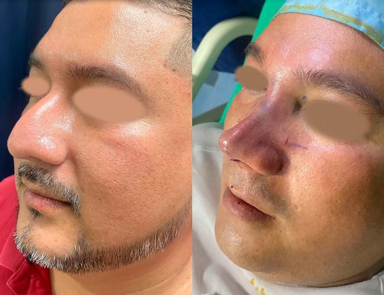 Rinoplastia (post-cirugía)
