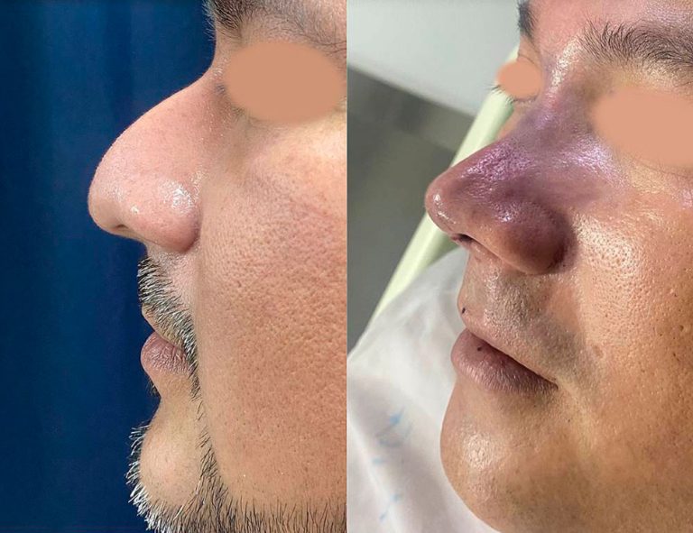 Rinoplastia (post-cirugía)