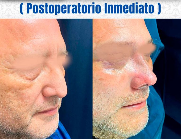 Rinoplastia y Blefaroplastia