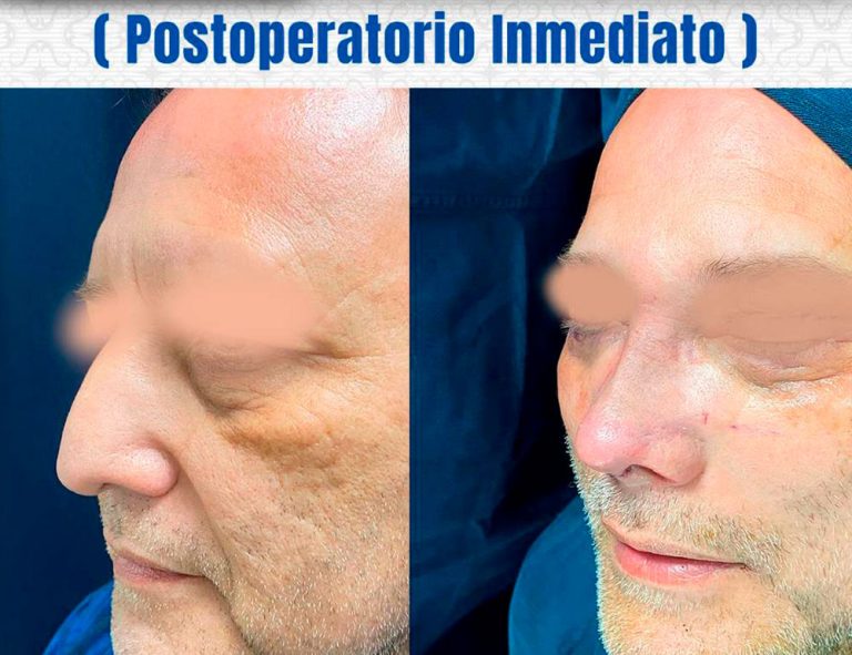 Rinoplastia y Blefaroplastia
