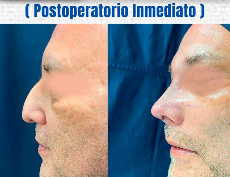 Rinoplastia y Blefaroplastia