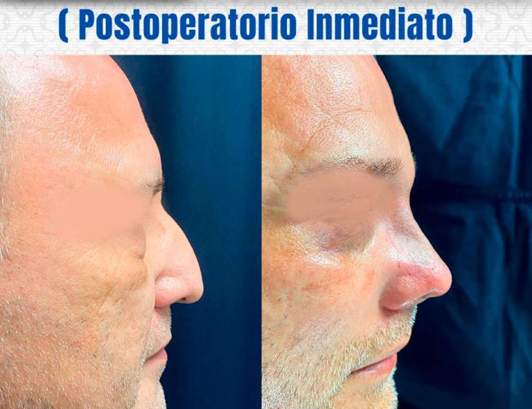 Rinoplastia y Blefaroplastia