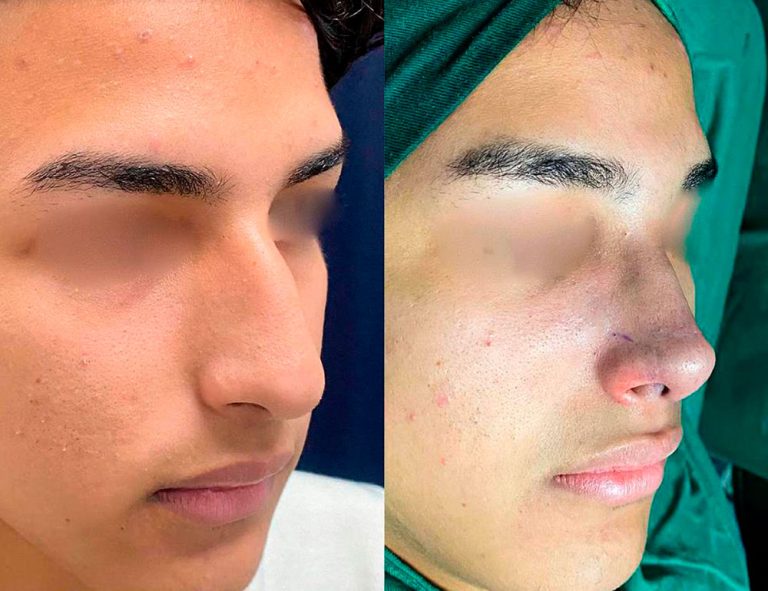 Rinoplastia (post-cirugía)