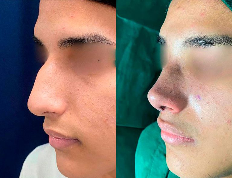 Rinoplastia (post-cirugía)